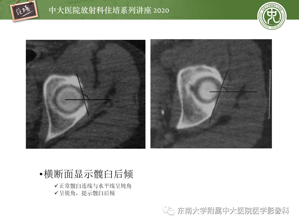 影像PPT - 【PPT】常见撞击综合征的影像诊断-40