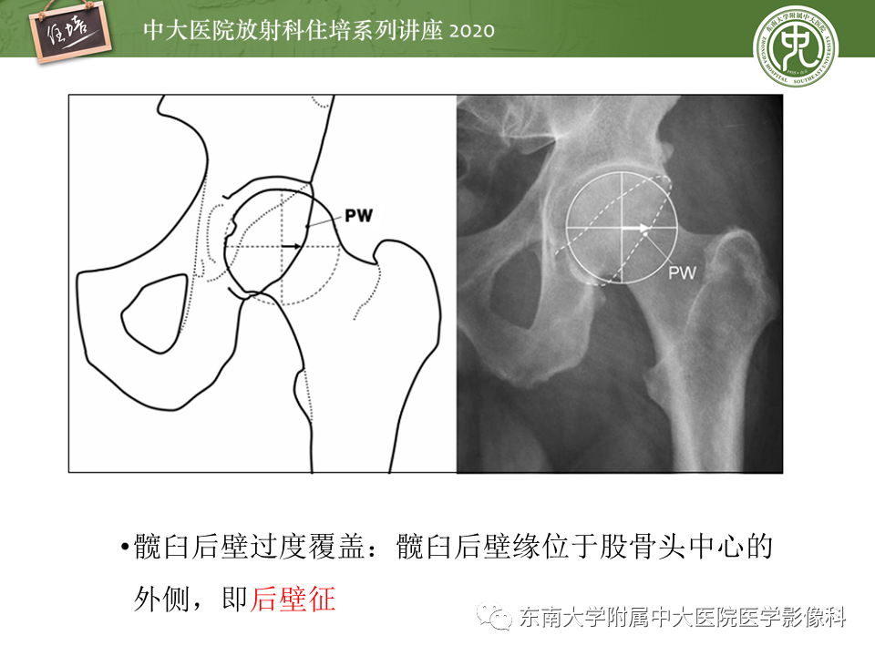 影像PPT - 【PPT】常见撞击综合征的影像诊断-41