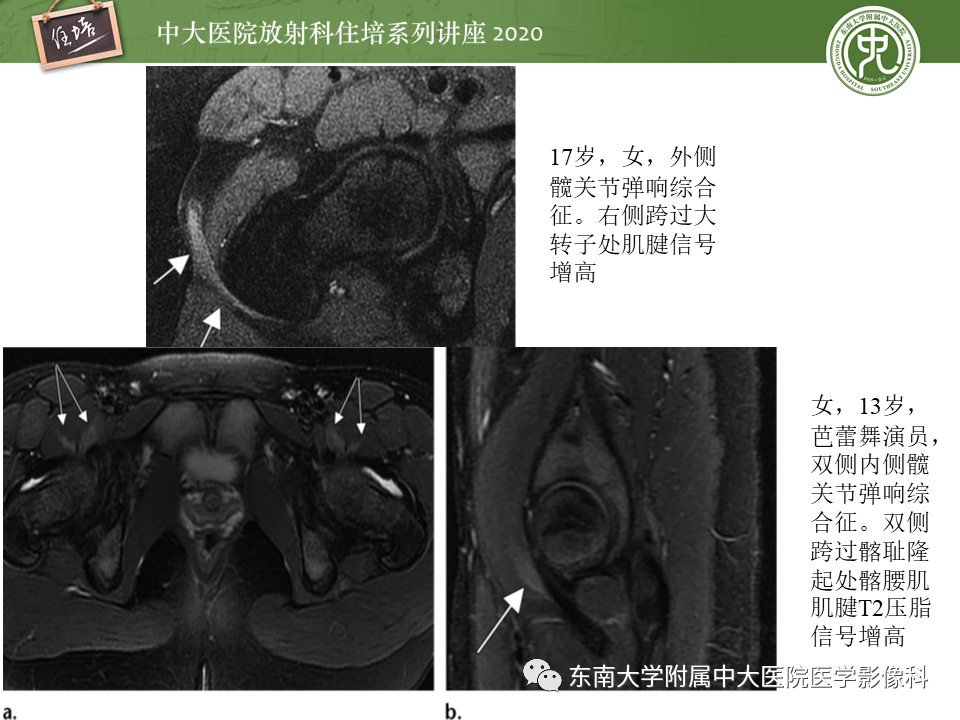 影像PPT - 【PPT】常见撞击综合征的影像诊断-45