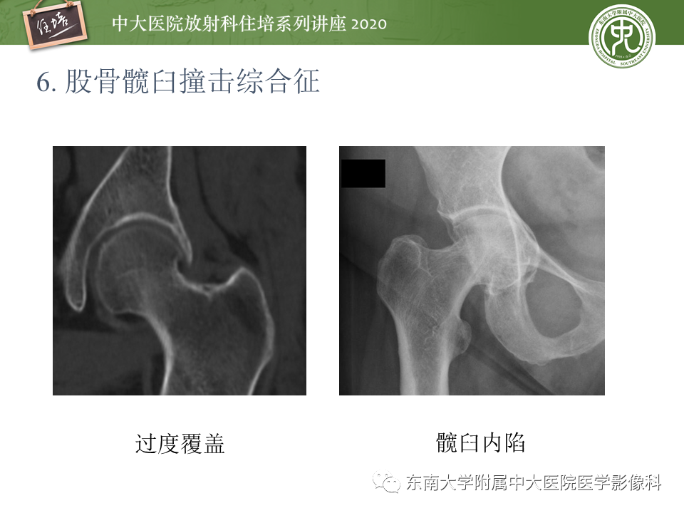 影像PPT - 【PPT】常见撞击综合征的影像诊断-42