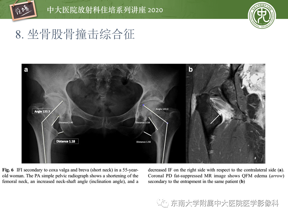 影像PPT - 【PPT】常见撞击综合征的影像诊断-47