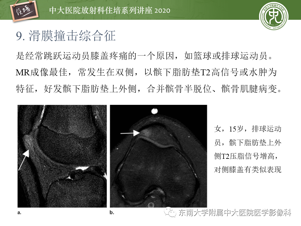 影像PPT - 【PPT】常见撞击综合征的影像诊断-48