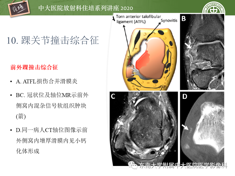 影像PPT - 【PPT】常见撞击综合征的影像诊断-52