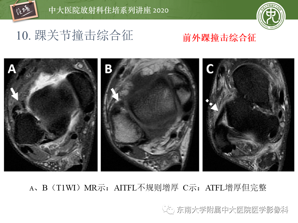 影像PPT - 【PPT】常见撞击综合征的影像诊断-53
