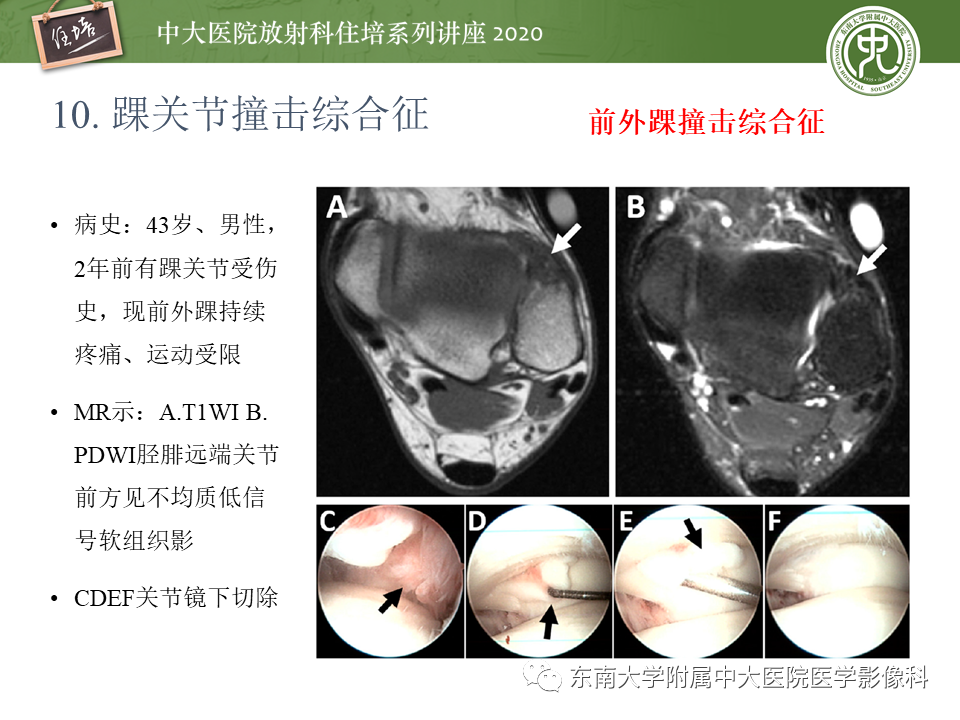 影像PPT - 【PPT】常见撞击综合征的影像诊断-54