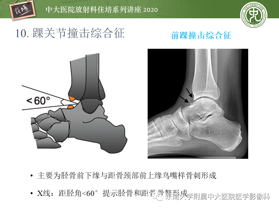 影像PPT - 【PPT】常见撞击综合征的影像诊断-56