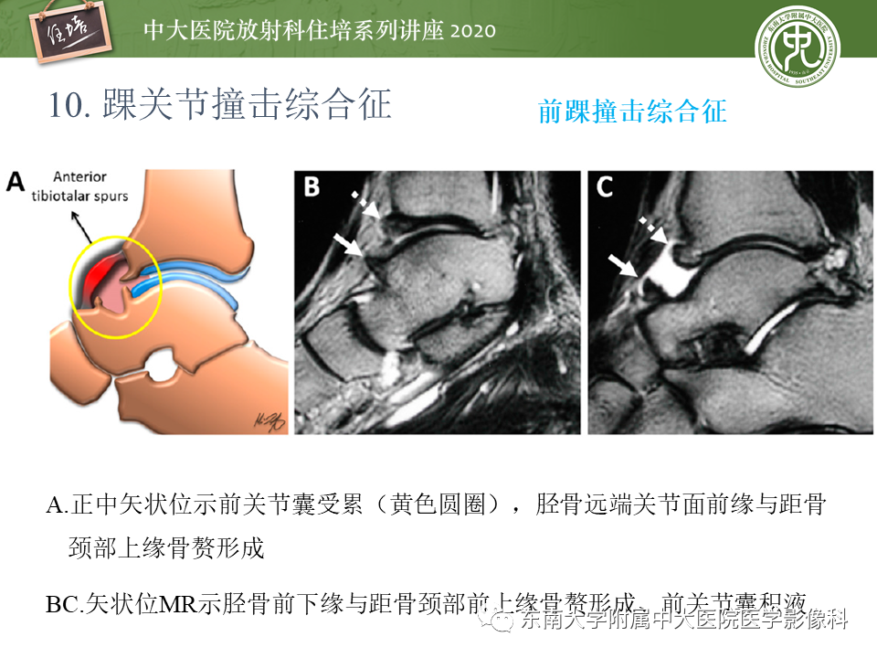 影像PPT - 【PPT】常见撞击综合征的影像诊断-57