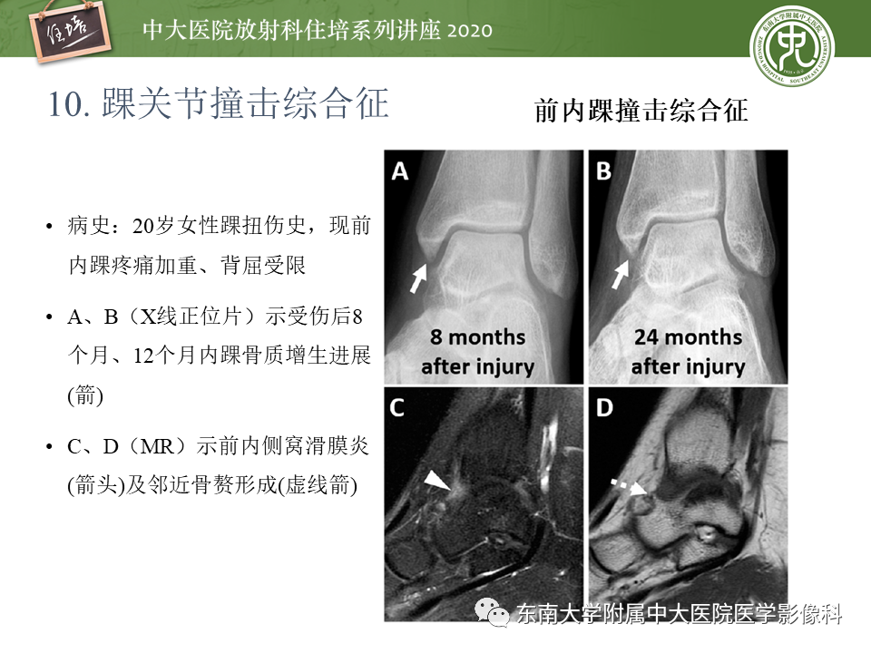 影像PPT - 【PPT】常见撞击综合征的影像诊断-58
