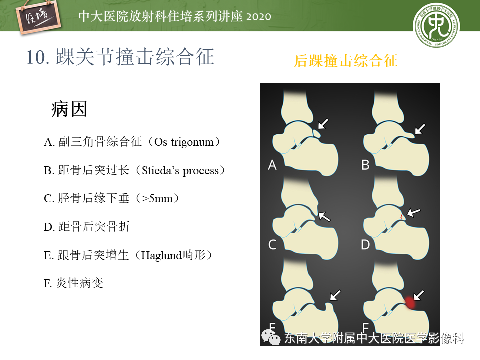 影像PPT - 【PPT】常见撞击综合征的影像诊断-61
