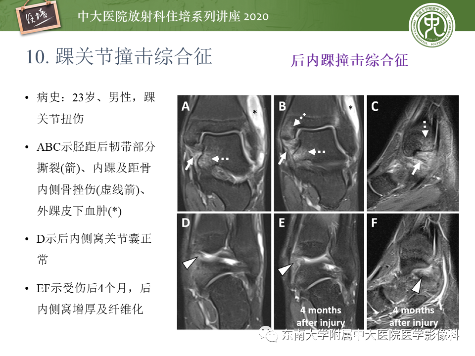 影像PPT - 【PPT】常见撞击综合征的影像诊断-59