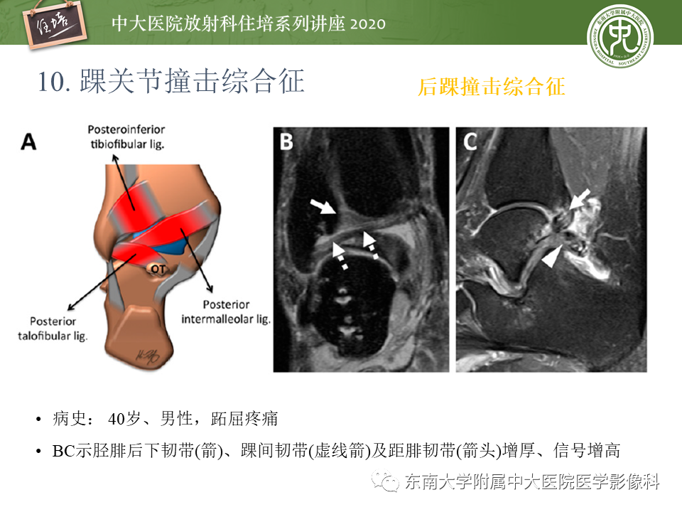 影像PPT - 【PPT】常见撞击综合征的影像诊断-64