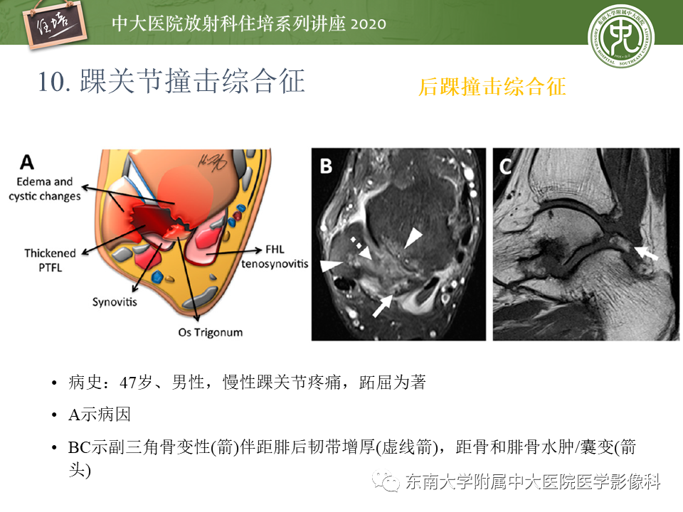 影像PPT - 【PPT】常见撞击综合征的影像诊断-63