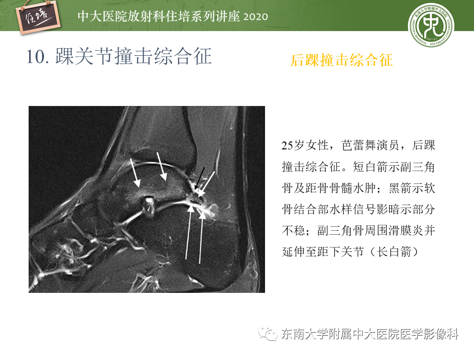 影像PPT - 【PPT】常见撞击综合征的影像诊断-65