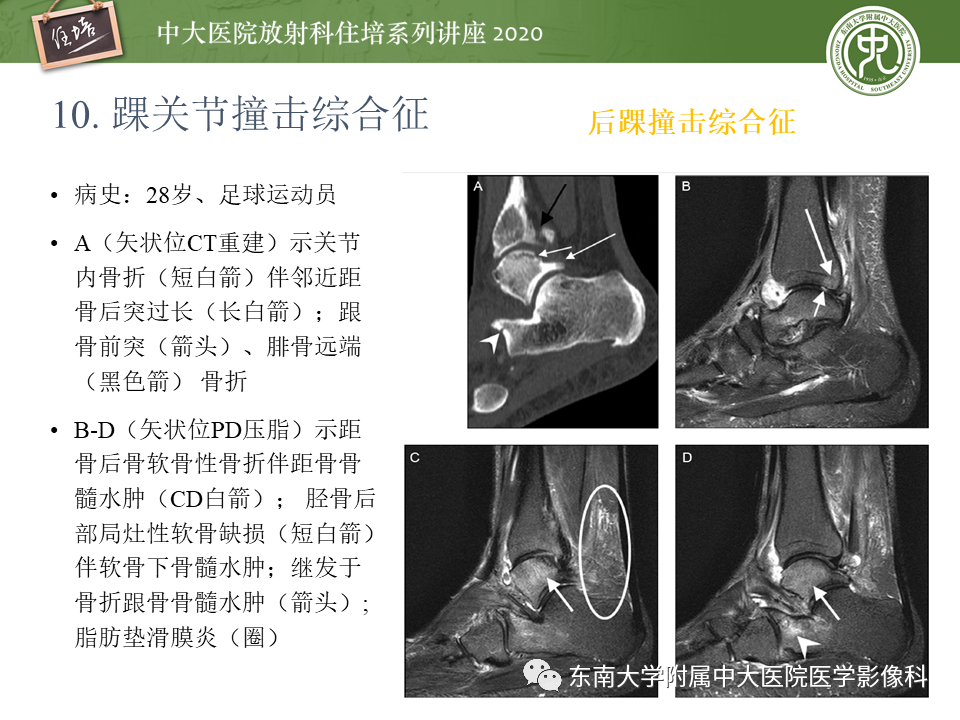 影像PPT - 【PPT】常见撞击综合征的影像诊断-66