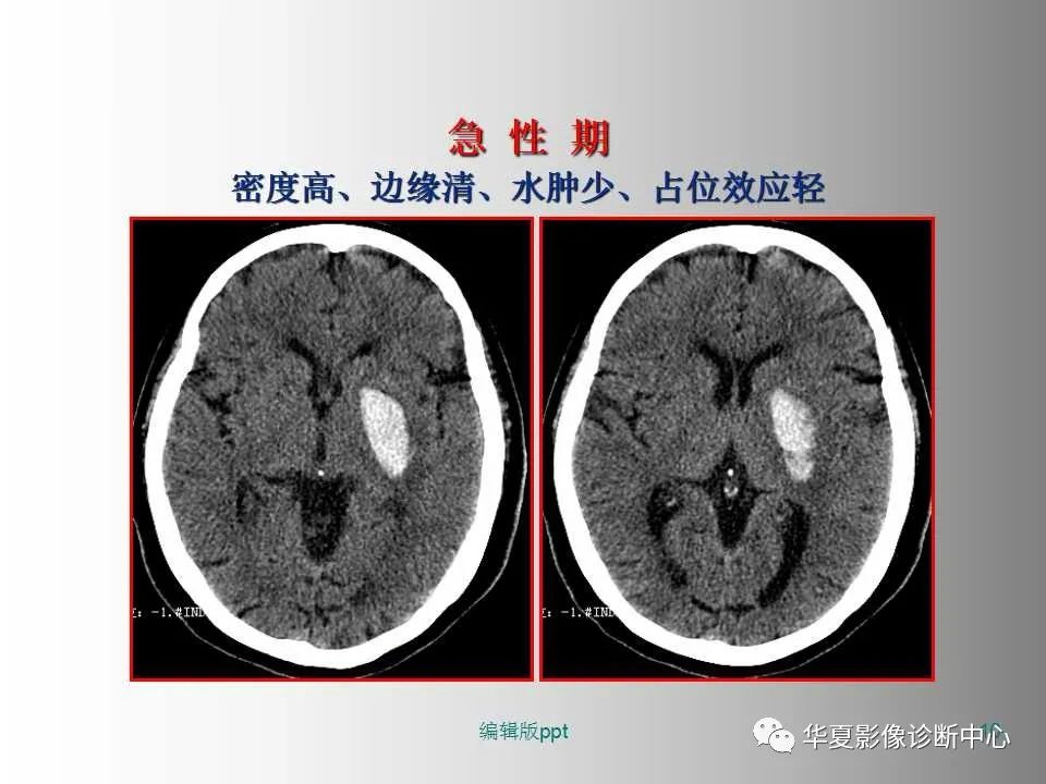 影像PPT - 【PPT】脑卒中影像诊断-9