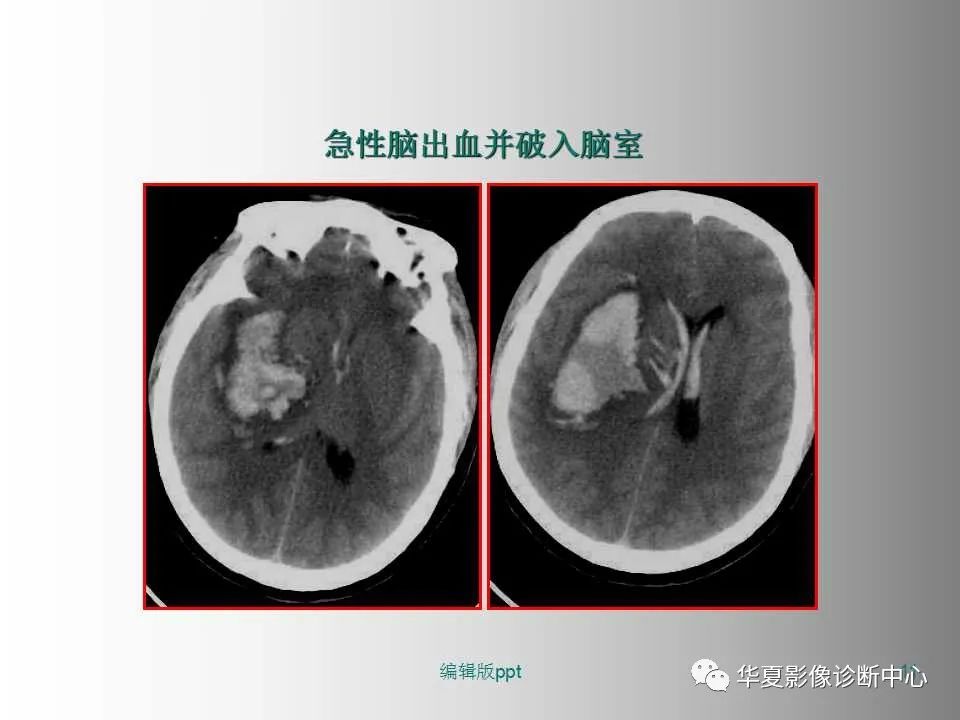 影像PPT - 【PPT】脑卒中影像诊断-10