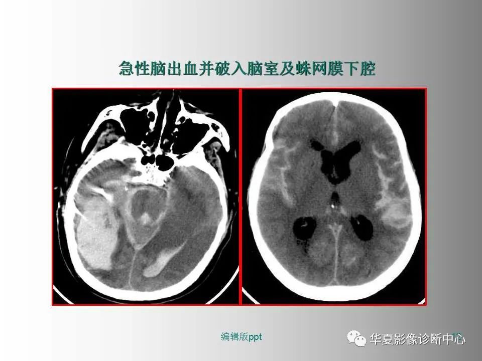 影像PPT - 【PPT】脑卒中影像诊断-11