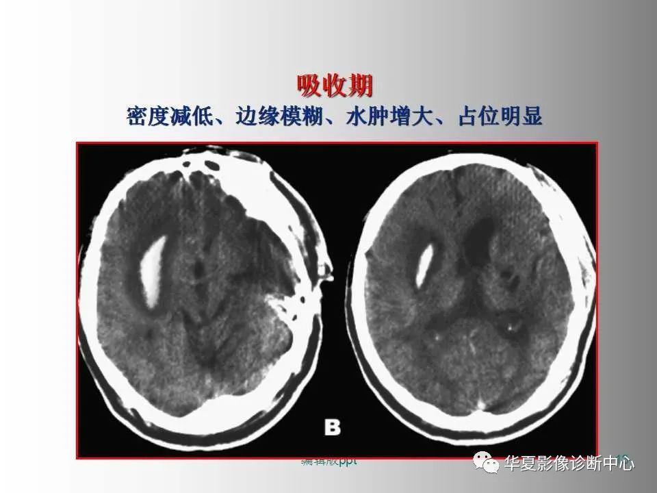 影像PPT - 【PPT】脑卒中影像诊断-12