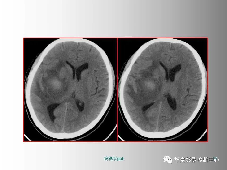 影像PPT - 【PPT】脑卒中影像诊断-13