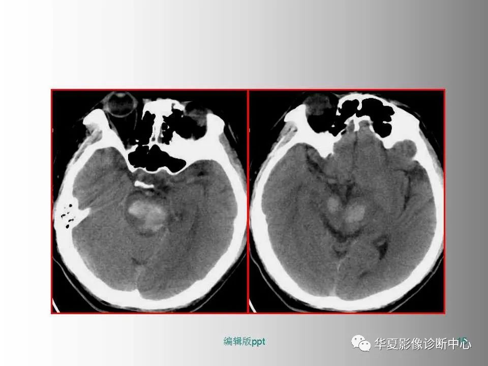 影像PPT - 【PPT】脑卒中影像诊断-14