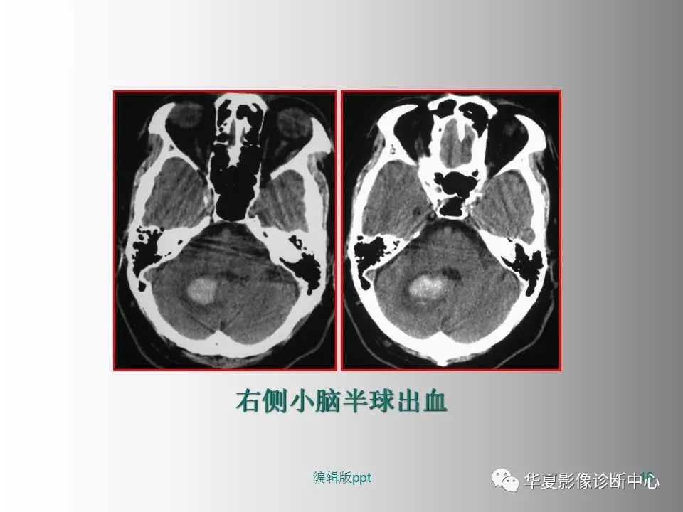 影像PPT - 【PPT】脑卒中影像诊断-15