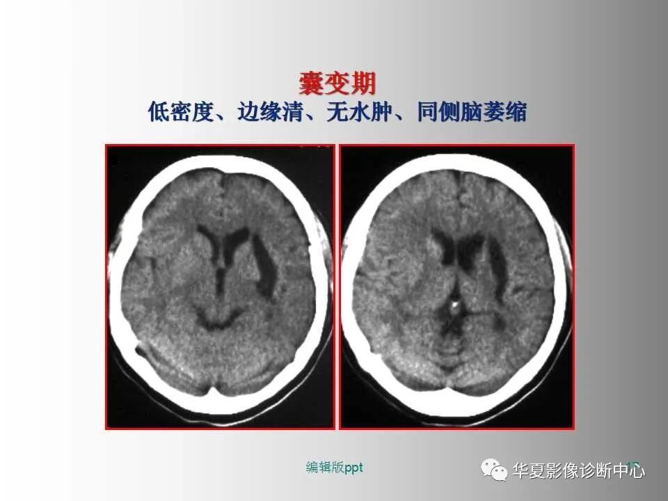 影像PPT - 【PPT】脑卒中影像诊断-16