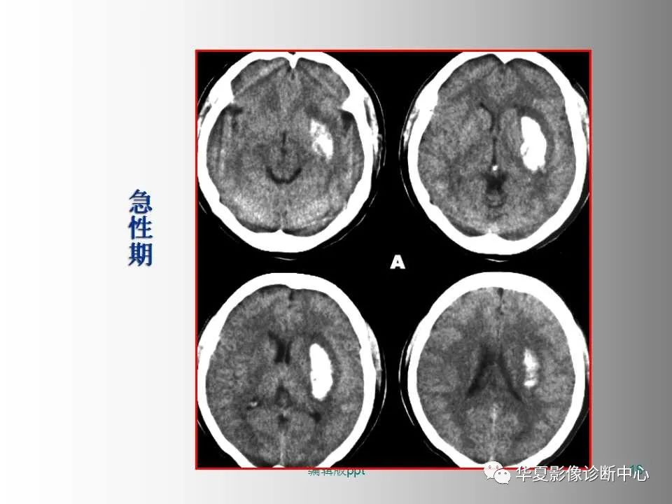 影像PPT - 【PPT】脑卒中影像诊断-17