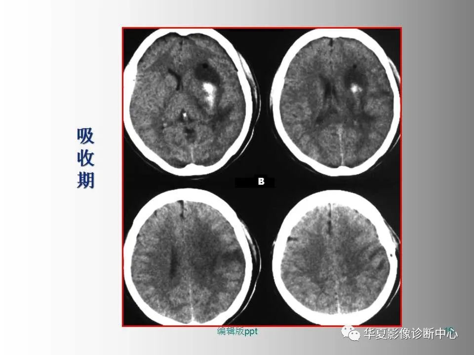 影像PPT - 【PPT】脑卒中影像诊断-18