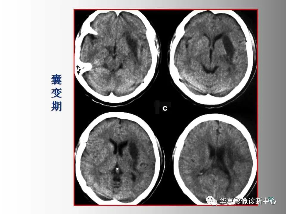 影像PPT - 【PPT】脑卒中影像诊断-19
