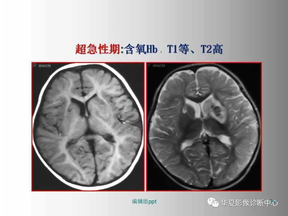 影像PPT - 【PPT】脑卒中影像诊断-23