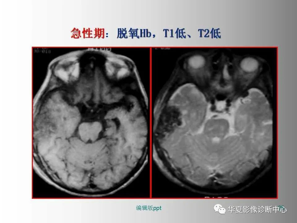 影像PPT - 【PPT】脑卒中影像诊断-24