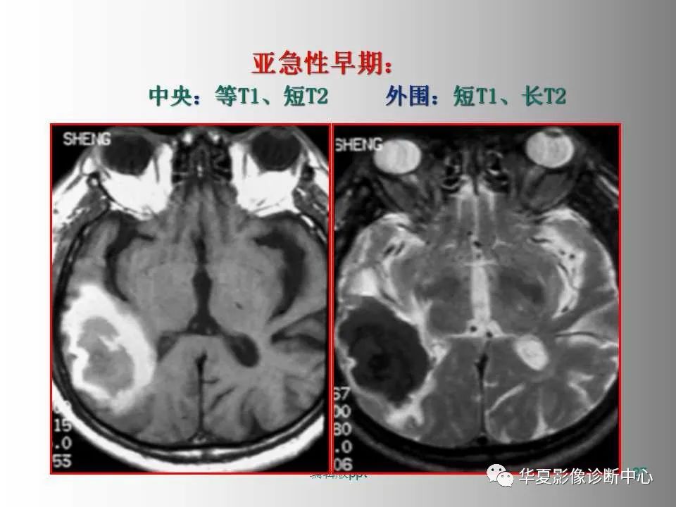 影像PPT - 【PPT】脑卒中影像诊断-26