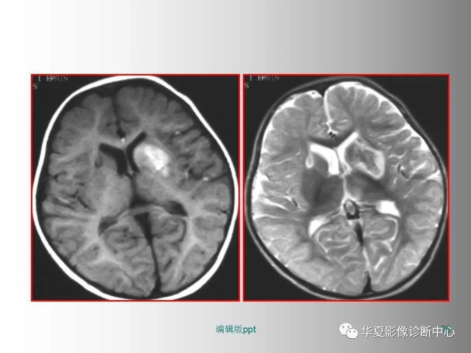 影像PPT - 【PPT】脑卒中影像诊断-27