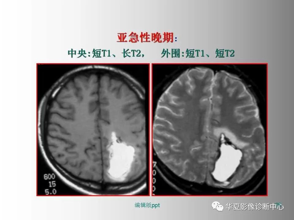 影像PPT - 【PPT】脑卒中影像诊断-28