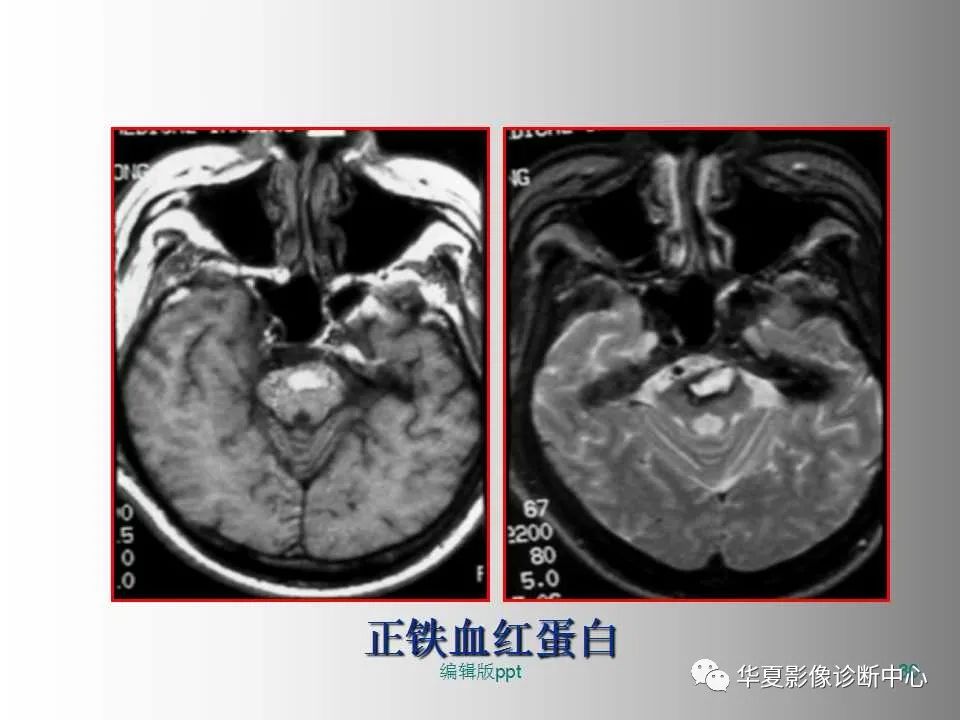 影像PPT - 【PPT】脑卒中影像诊断-29