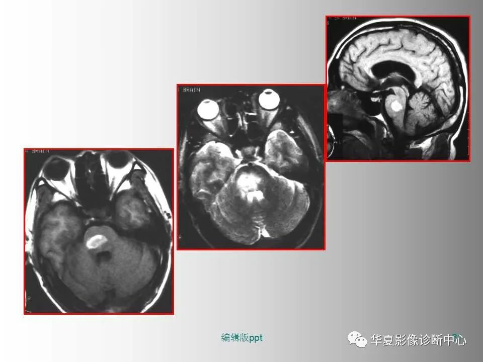 影像PPT - 【PPT】脑卒中影像诊断-30