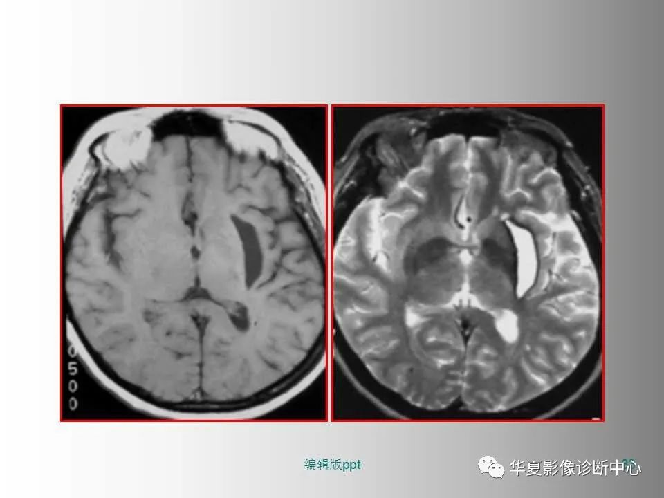 影像PPT - 【PPT】脑卒中影像诊断-32