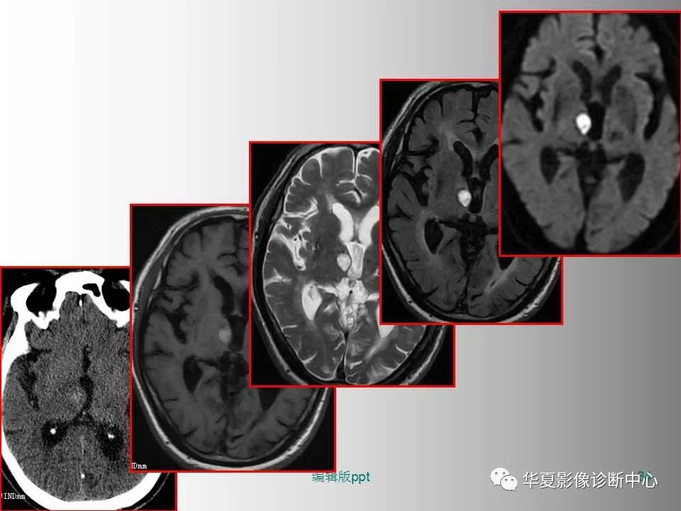 影像PPT - 【PPT】脑卒中影像诊断-33
