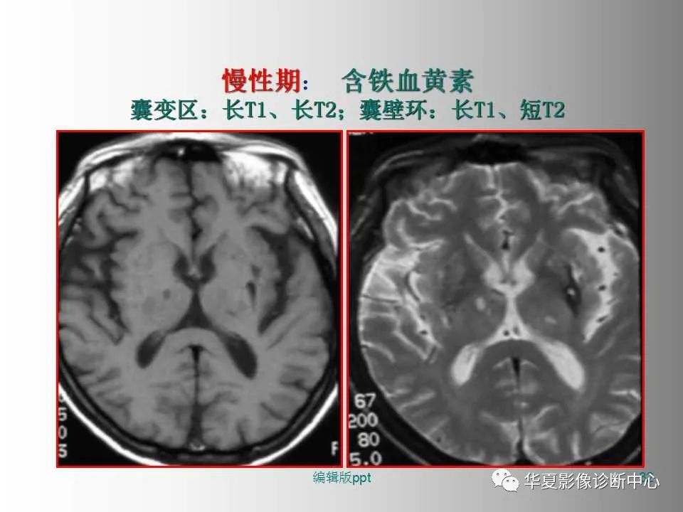 影像PPT - 【PPT】脑卒中影像诊断-31