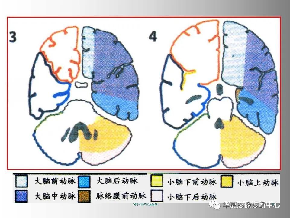 影像PPT - 【PPT】脑卒中影像诊断-40