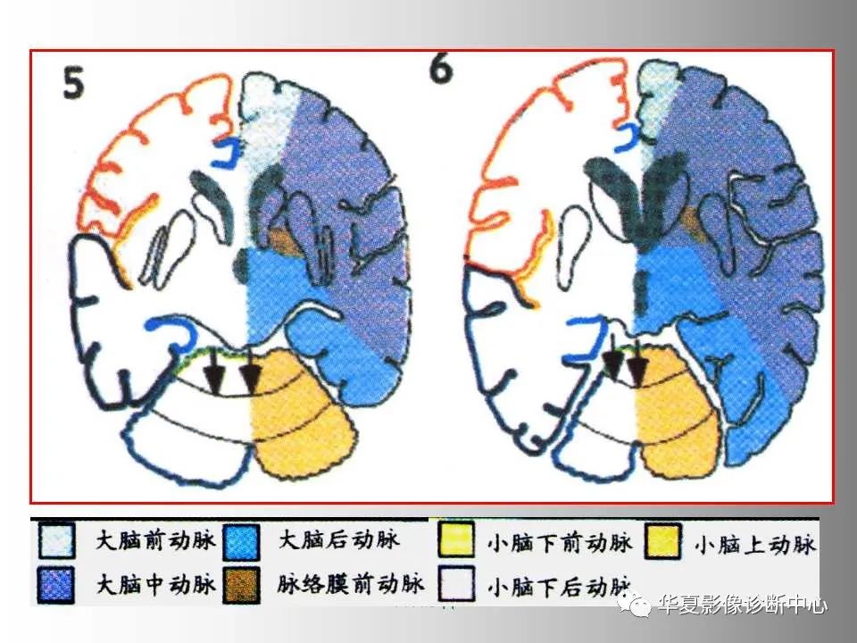 影像PPT - 【PPT】脑卒中影像诊断-41