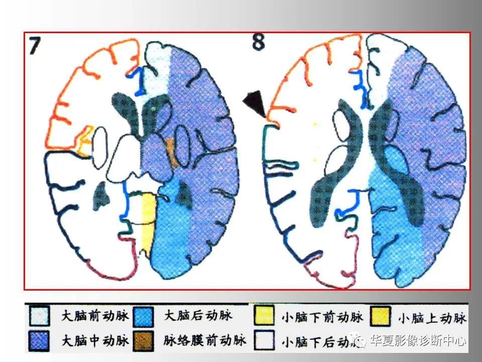 影像PPT - 【PPT】脑卒中影像诊断-42