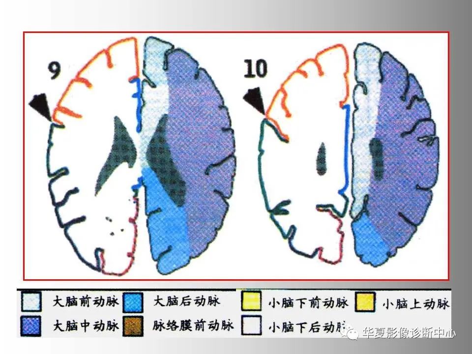 影像PPT - 【PPT】脑卒中影像诊断-43