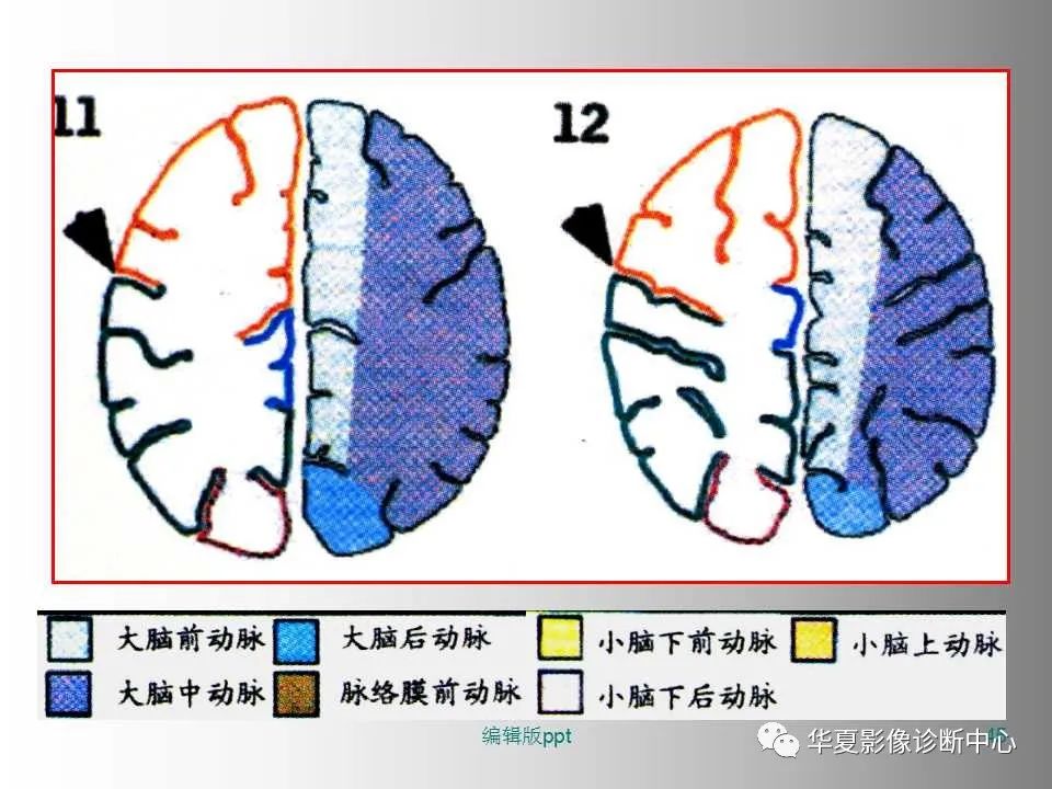 影像PPT - 【PPT】脑卒中影像诊断-44