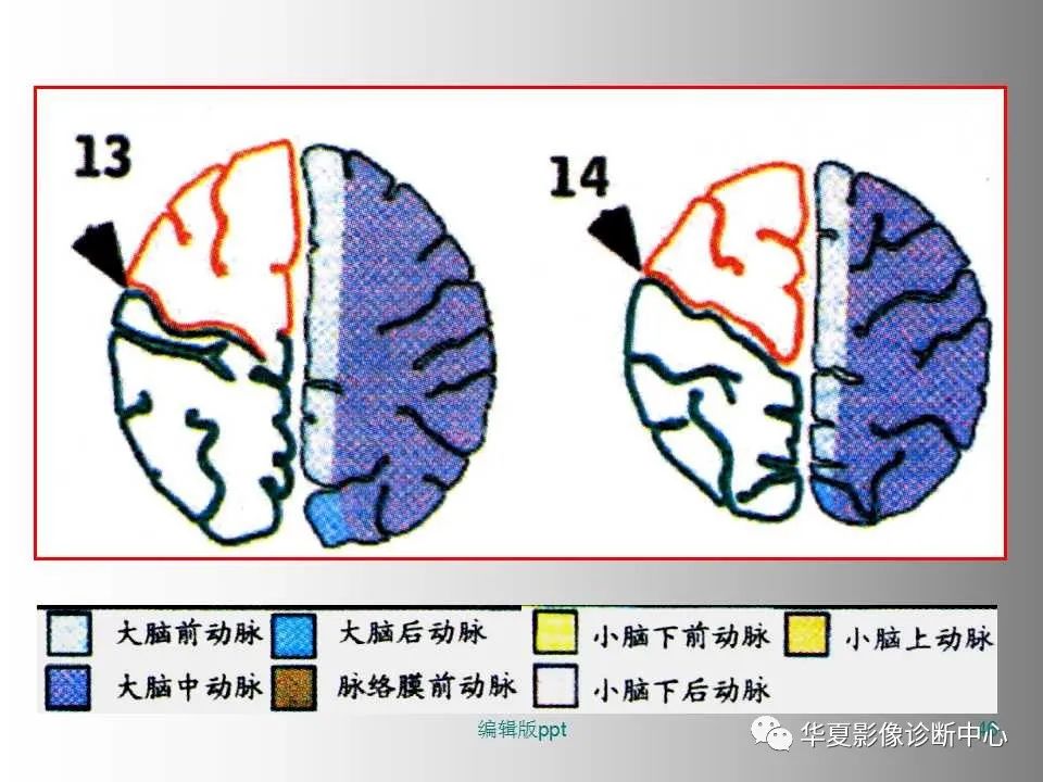 影像PPT - 【PPT】脑卒中影像诊断-45