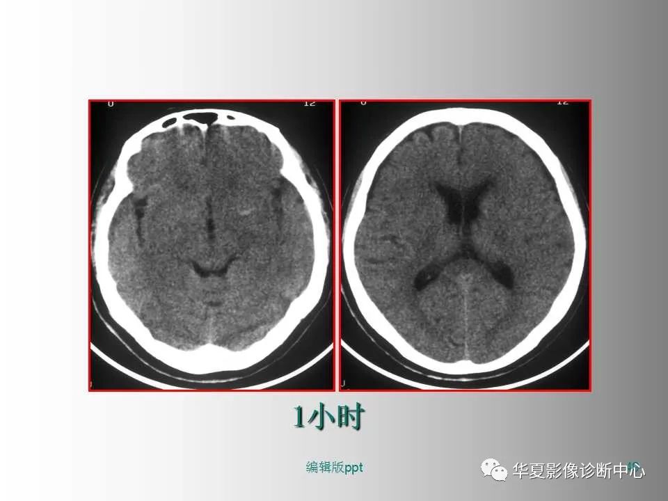 影像PPT - 【PPT】脑卒中影像诊断-48