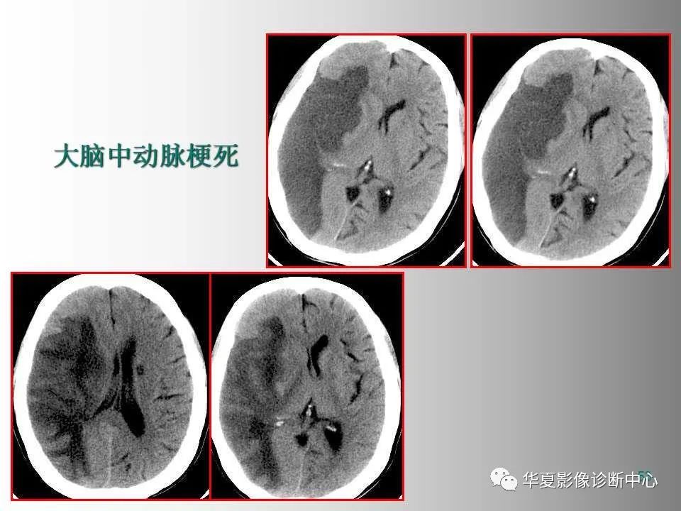 影像PPT - 【PPT】脑卒中影像诊断-52