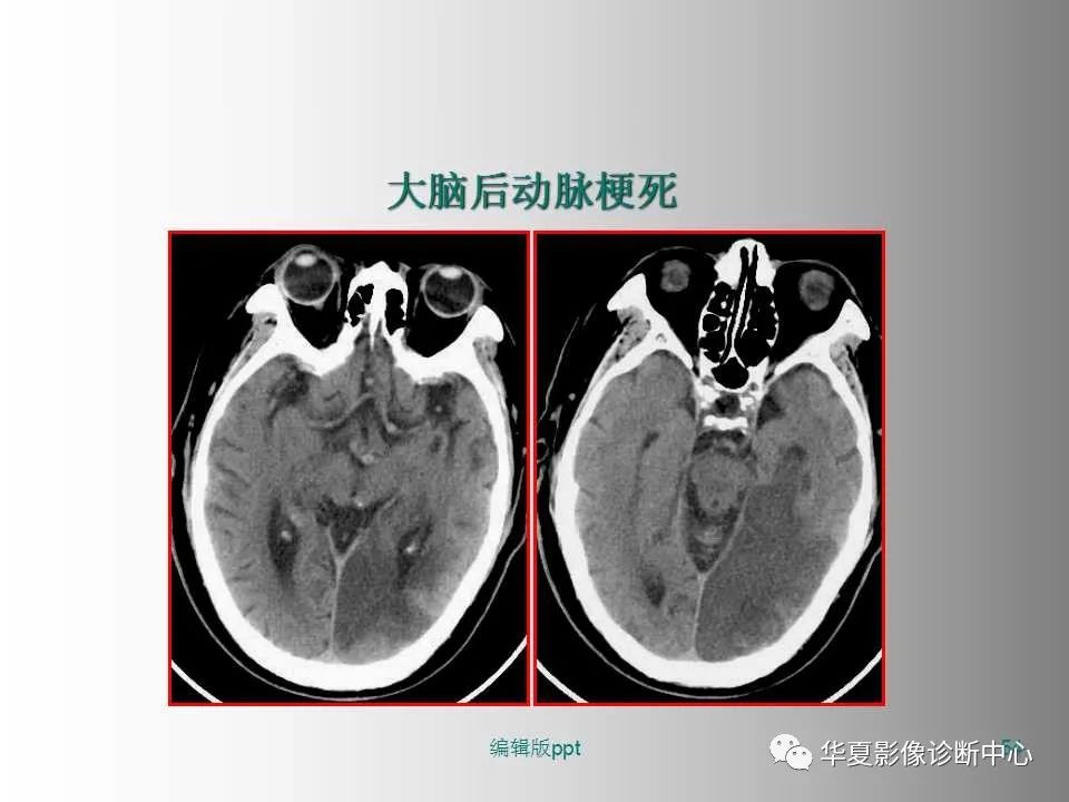 影像PPT - 【PPT】脑卒中影像诊断-53
