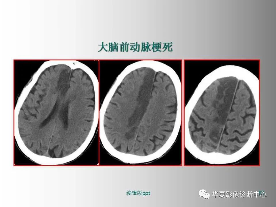 影像PPT - 【PPT】脑卒中影像诊断-51