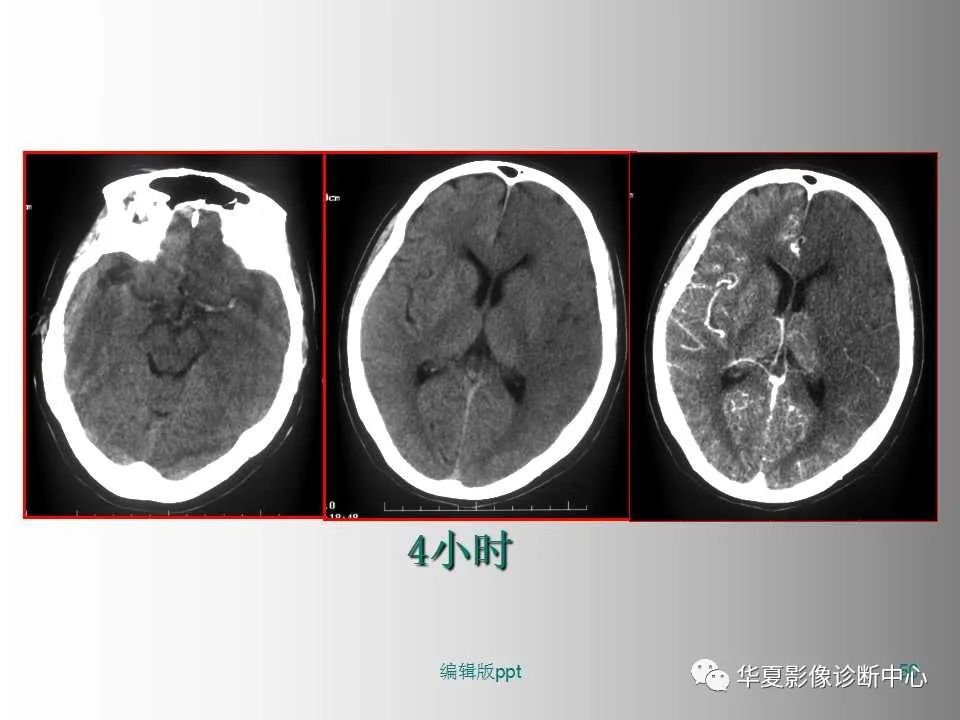 影像PPT - 【PPT】脑卒中影像诊断-49